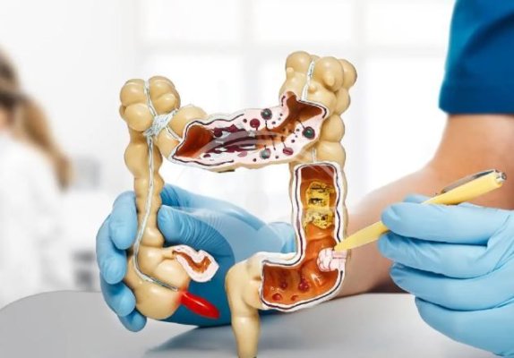 Cancer de colon: semnul care poate fi observat la toaletă
