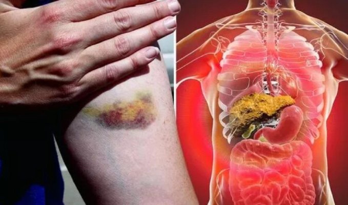 Patru modificări ale pielii care ar putea indica stadiul cel mai sever al bolii hepatice grase