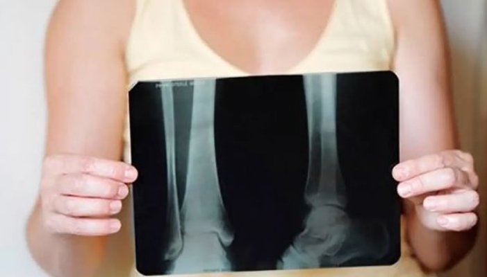 Șase moduri de a îmbunătăți densitatea osoasă după menopauză