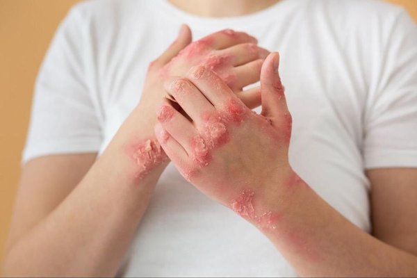Probleme cardiace și psoriazis: Care este legătura dintre ele?