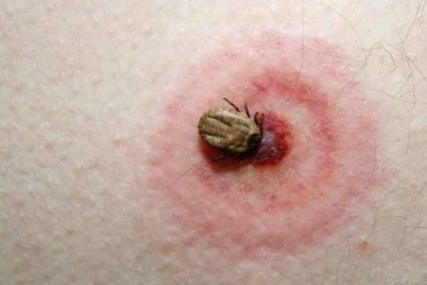 Primul semn al infectării cu boala cauzată de mușcătura unei căpușe infectate. La ce să fii atent