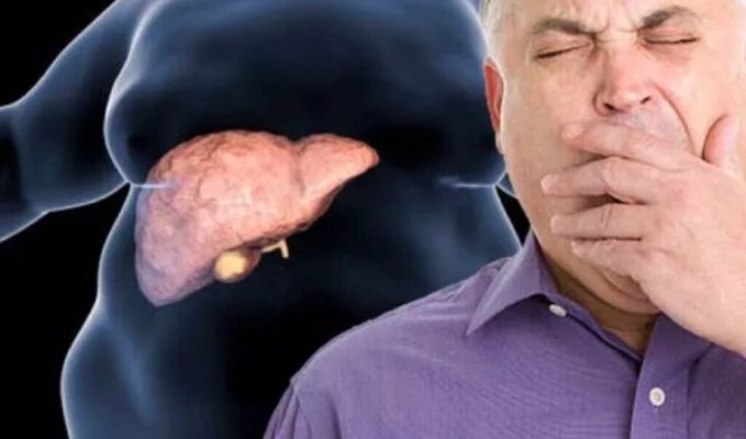 Reguli de urmat pentru pacientii diagnosticati cu boala de ficat gras