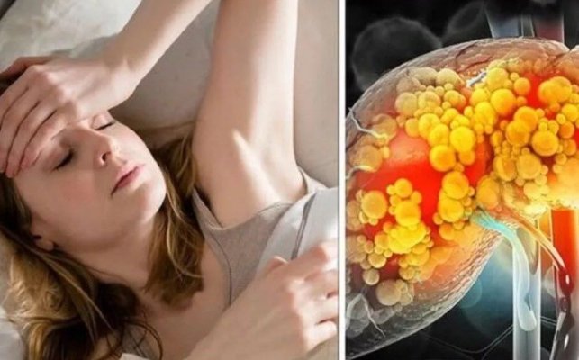 Două semne ale bolii hepatice grase severe care ar putea fi confundate cu insolația