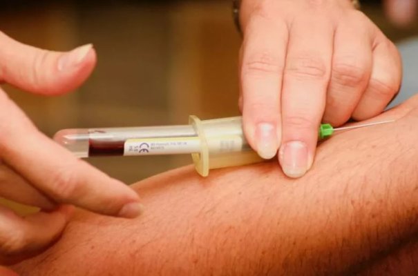 Colesterolul prea mic, posibil semn de hepatită sau cancer