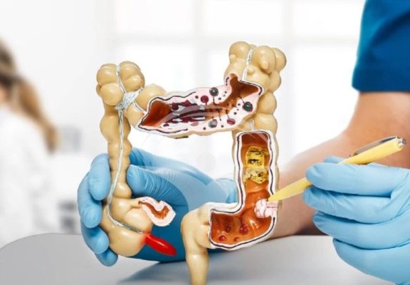 Peste 200.000 de persoane au fost testate în cadrul unui proiect-pilot de screening pentru cancerul colorectal