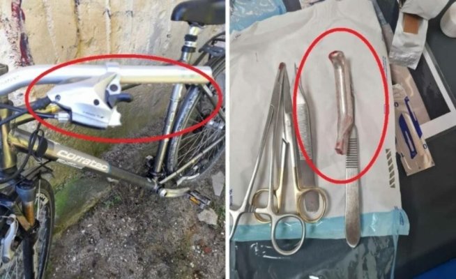 Un medic, acuzat că i-a cusut piciorul unui bărbat cu frâna de la bicicletă în interior