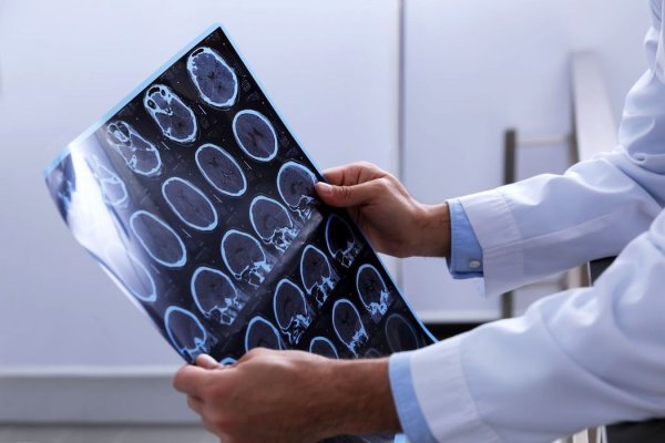 Rezultate umitoare în lumea medicală: Un implant cerebral le dă voce oamenilor care nu pot vorbi