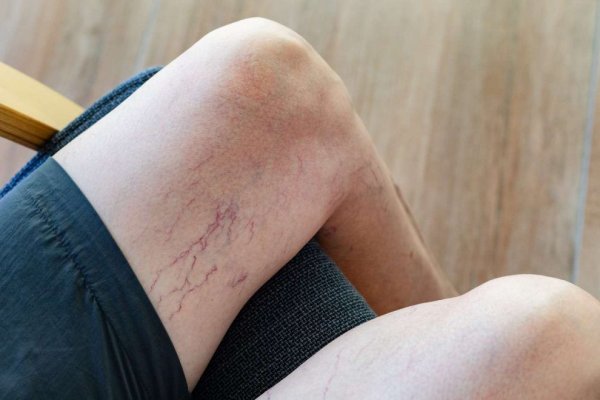 Venele tip pânză de păianjen: Un defect estetic sau primul semn al unei boli grave?
