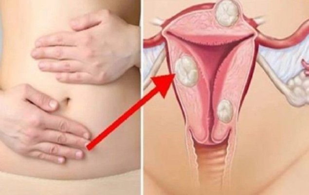 Endometrioza: simptome, sarcina și infertilitate. Cum se tratează