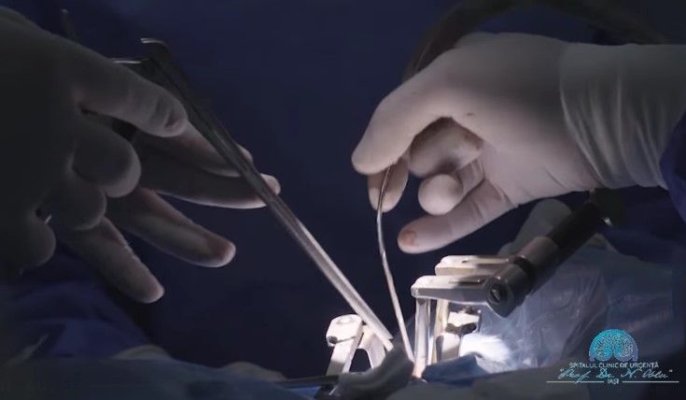 O tumoră de 20 centimetri, ce cuprindea şapte vertebre ale unui copil de 13 ani, extirpată de medici