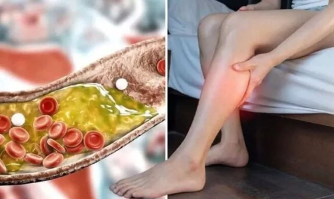 Simptomul colesterolului ridicat care provoacă dureri „severe” . Nu trebuie să îl ignori