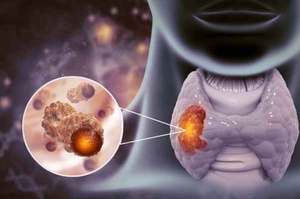 Probleme cu tiroida: Trei simptome care nu ar trebui niciodată ignorate