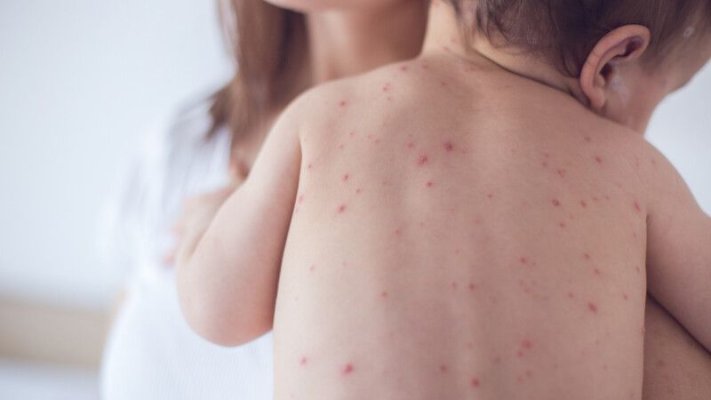 România, în prag de epidemie de rujeolă  