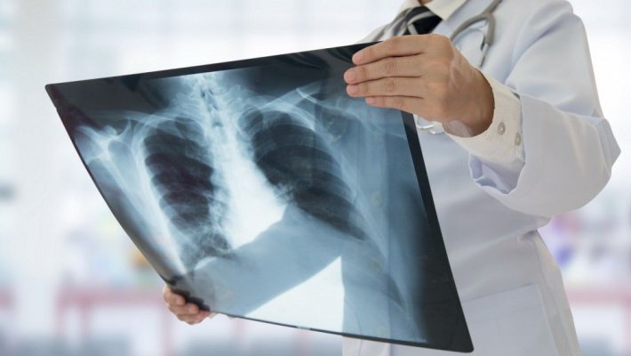 Sindromul plămânului alb pune în alertă lumea medicală: Pneumonia s-a răspândit și-n Europa