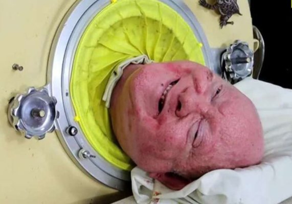 Bărbatul din Texas care a trăit timp de şapte decenii într-un ''plămân de fier'' a murit la 78 de ani