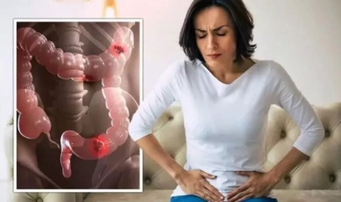5 obiceiuri sănătoase de viață ar putea reduce riscul de a dezvolta sindromul intestinului iritabil