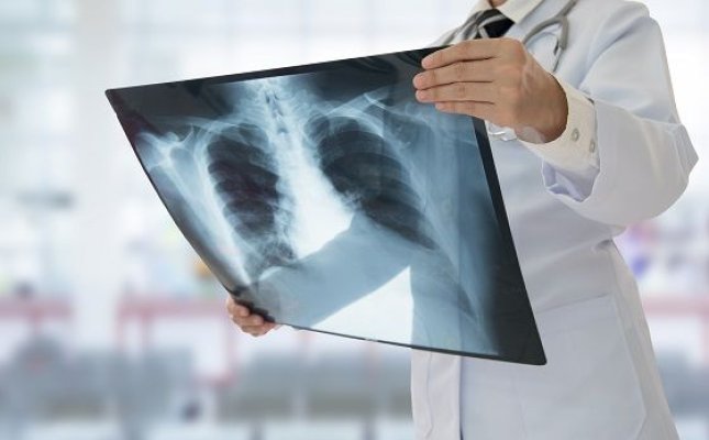 Expert ONU despre TBC: Există o stigmă asociată cu tuberculoza şi atunci omul preferă să nu fie văzut