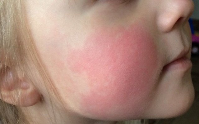 A cincea boală a copilăriei: Boala obrajilor pălmuiți sau eritemul infecțios