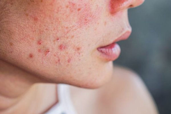 Medic dermatolog: Afecțiunile pielii sunt expresii cutanate ale unor boli psihice
