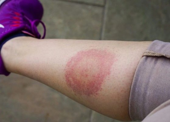 Simptome ale bolii Lyme pe care nu trebuie să le ignorați