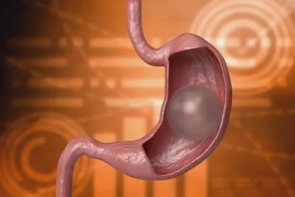 Balonul gastric considerat prea riscant, retras de pe piaţa franceză