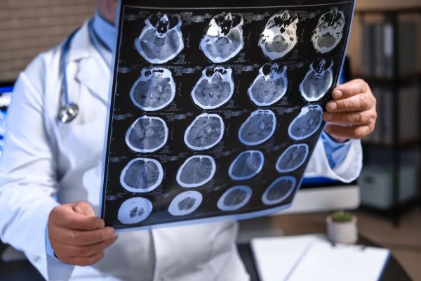 Vitamina A în organism ar putea contribui la prevenirea bolilor ce duc la deteriorarea creierului