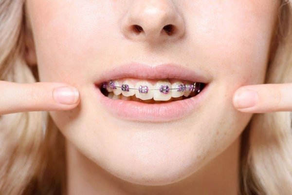 Îngrijirea și întreținerea aparatului dentar: 5 sfaturi utile
