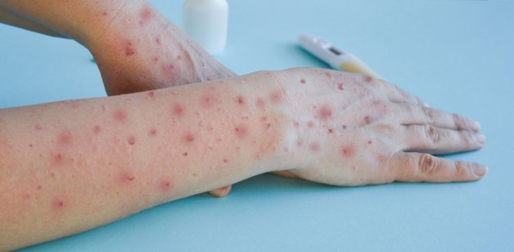 Mpox se răspândește tot mai mult: „O urgenţă de sănătate publică de interes internaţional“