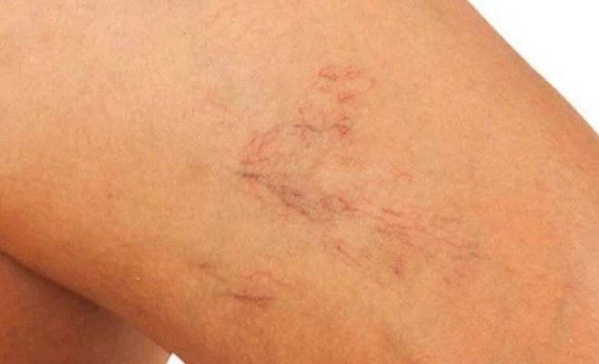 Hepatita autoimună poate apărea la oricine. Vasele de sânge sparte pe picioare, unul din semnele alarmante