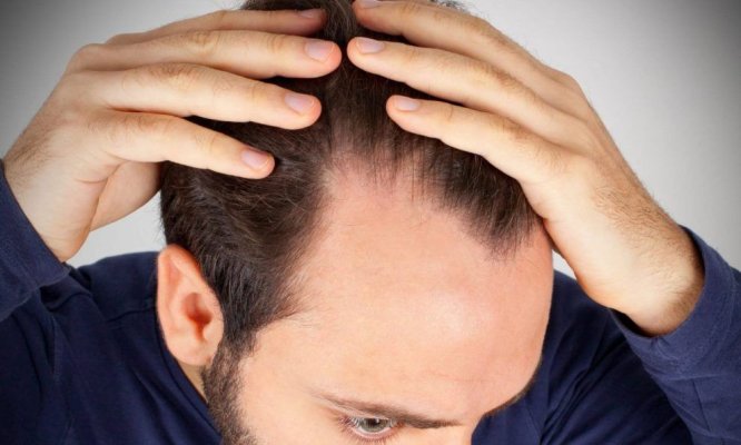 Un studiu ADN de amploare arată că selecția naturală a favorizat părul roșcat și a redus predispoziția la chelie la bărbați