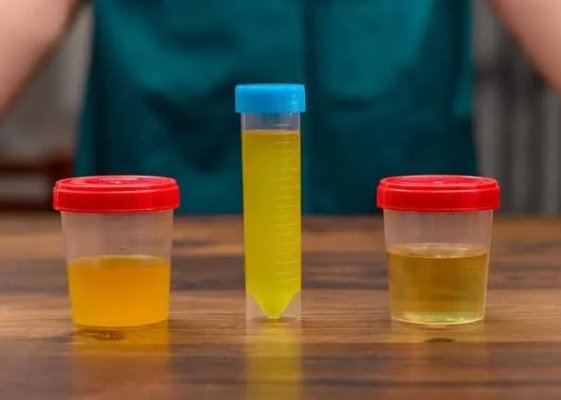Ce indică albumina din urină? Problema de sănătate pe care o semnalează