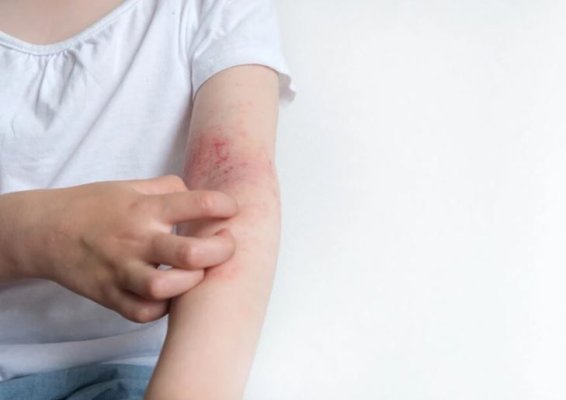 Dermatita atopică, afecțiunea de care suferă 10% din români