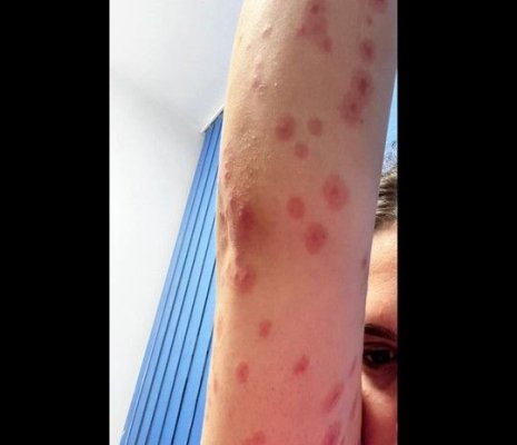 O studentă a ajuns la spital cu zeci de înţepături de ploşniţe, după ce s-a cazat într-un cămin din București
