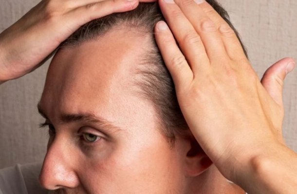 Tot ce trebuie să știi despre alopecia androgenetică