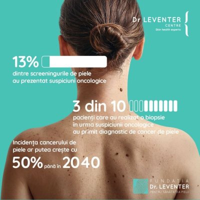 Medic: Doar 2 din 10 persoane recunosc semnele melanomului