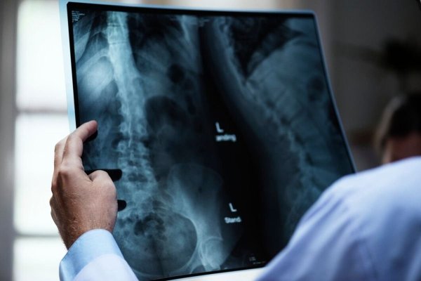 Gadgeturile și tehnologia, cauza creșterii cazurilor de scolioză în rândul tinerilor