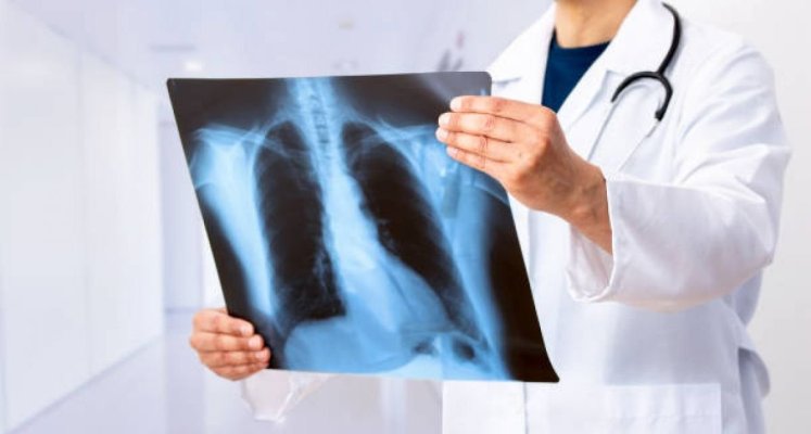 România rămâne țara cu cele mai multe cazuri de tuberculoză din UE, deși Rafila anunță că numărul lor a scăzut