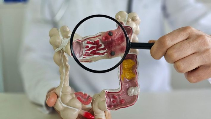 Incidența cancerului colorectal crește rapid la sub 50 de ani. Cauzele rămân un mister