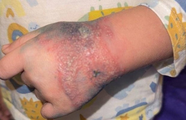 Anchetă la un spital din țară după ce un copil s-ar fi infectat la o mână de la o branulă neschimbată