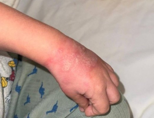 Un copil s-ar fi ales cu mâna tumefiată, după ce ar fi stat patru zile în spital cu branula neschimbată