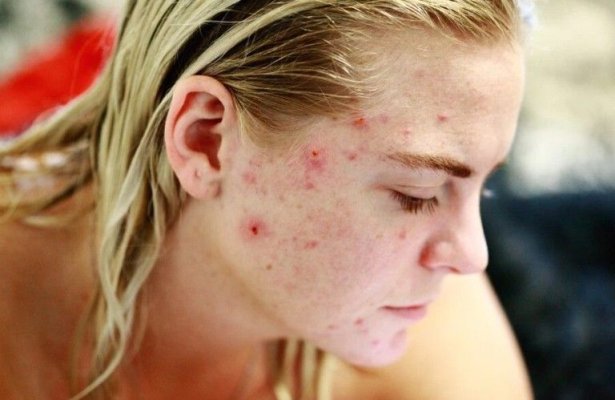 Avertismentul specialiștilor: Acneea severă poate fi un semn de cancer