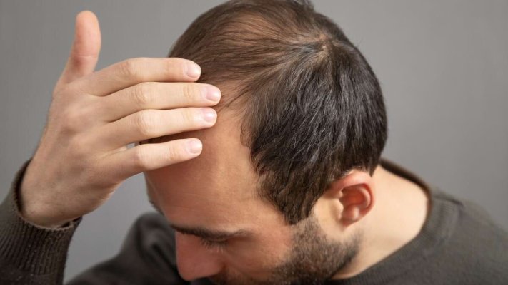 Un medic trage un semnal de alarmă: Alopecia afectează grav calitatea vieții