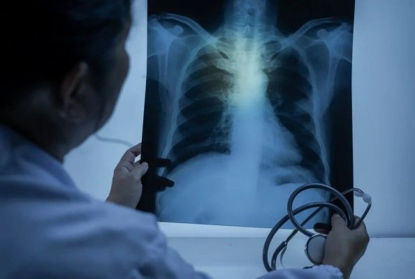 Pneumolog: Gripa provoacă cele mai grave simptome pulmonare, mai nocive decât Covid-19