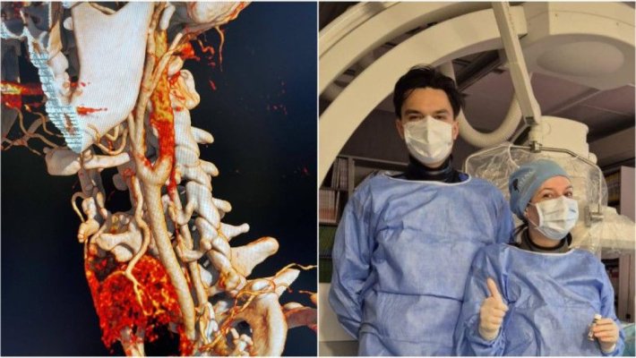 Prima embolizare arterială tiroidiană, realizată la Spitalul Universitar de Urgență București