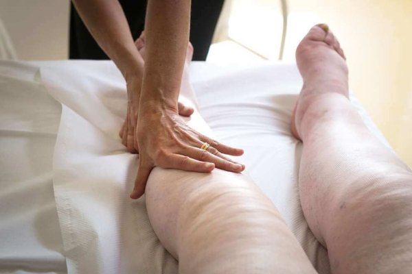 Abrudean: Limfedemul, o boală ce trebuie adusă în atenția publică; nu putem trata ceea ce ignorăm