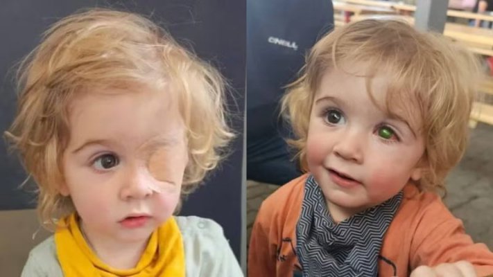 Un băiat de doi ani a rămas fără vedere după ce a fost sărutat de o persoană cu herpes