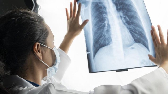 Cercetătorii au găsit legătura între dietă și cancerul pulmonar. Care ar fi alimentele periculoase