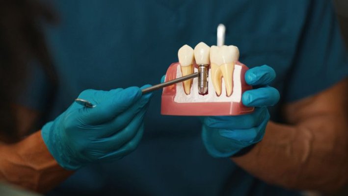 La ce riscuri te expui dacă ai lucrări dentare din metal