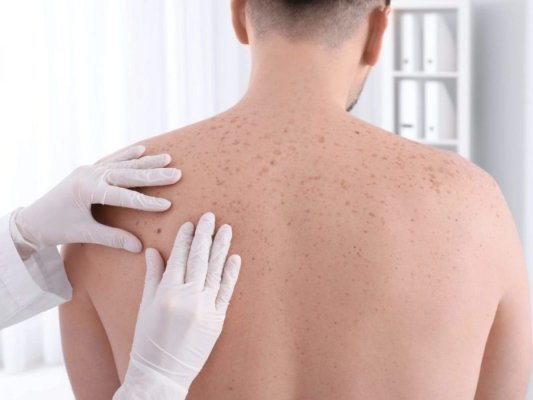 Societatea Română de Dermatologie lansează campania de prevenire a cancerului de piele