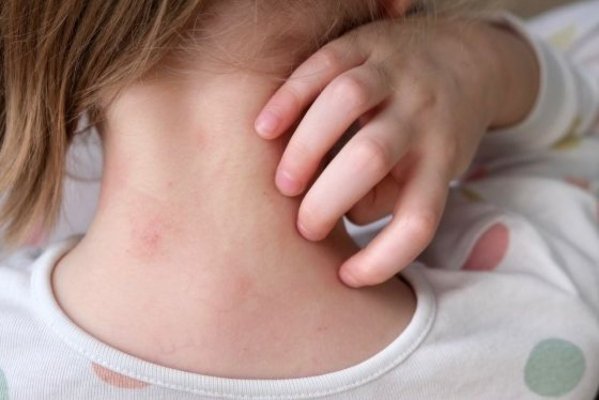 Nicoleta Pauliuc: Politicile de sănătate trebuie să răspundă nevoilor reale ale pacienților cu dermatită atopică